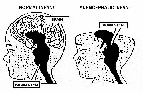 Anencephaly Syndrome